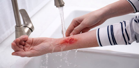 Great news for burns injury patients – This newly developed biomaterials based bandage would speed up their healing process!!