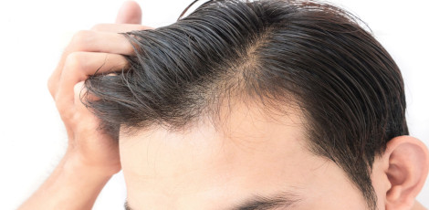 Important ways to reduce dandruff during the winter season!!