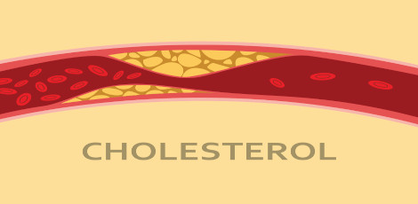 Relationship between yellow coloured growths on the eyelids and heart attacks etc – A simple method to treat high cholesterol levels at home!!