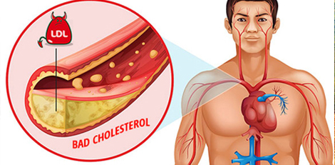 Swapping these foods with healthy foods would lower cholesterol levels and improve heart health!!