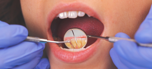 Screen addiction and tooth decay – Important things to know!!