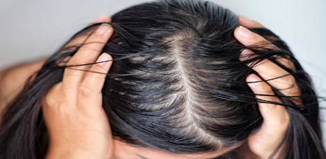 Say goodbye to the issue of greasy and oily hairs by these superb home remedies!! Say goodbye to the issue of greasy and oily hairs by these superb home remedies!!