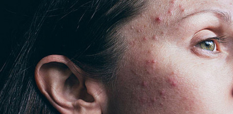 Your face acne could be due to these foods, try to avoid them!! Your face acne could be due to these foods, try to avoid them!!