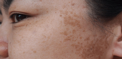 Do you know that melasma can be due to these important reasons?