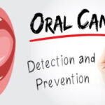 Know about these important signs of oral cancer and get treated immediately!!
