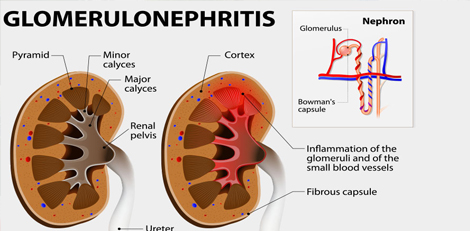 What is glomerulonephritis - Its causes, symptoms, treatment etc!!