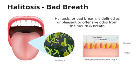 Having Halitosis or Bad breath problem? - These can be the important reasons!! Having Halitosis or Bad breath problem? - These can be the important reasons!!