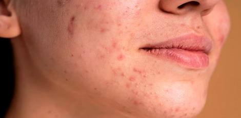 Various important reasons for getting chin acne, ways to manage etc!!