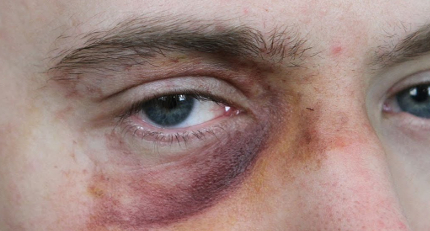 How high levels of uric acid in us could harm our eyesight or vision? How high levels of uric acid in us could harm our eyesight or vision?