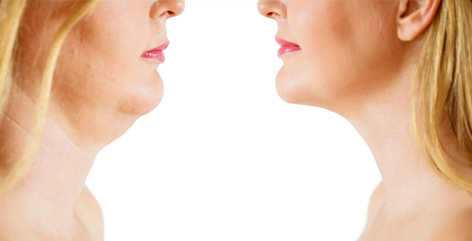 How to Reduce Face Fat Naturally