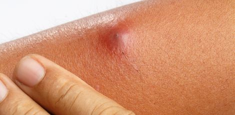 Boils: Causes, Symptoms, and Treatment