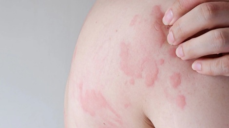 Hives (Urticaria) Alert: Causes, Symptoms & Prevention Tips You Should Know