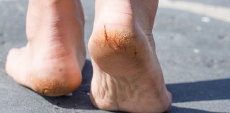 Effective Home Remedies to Treat Cracked Heels