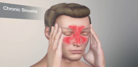Sinusitis Symptoms, Causes & Treatment: Complete Guide